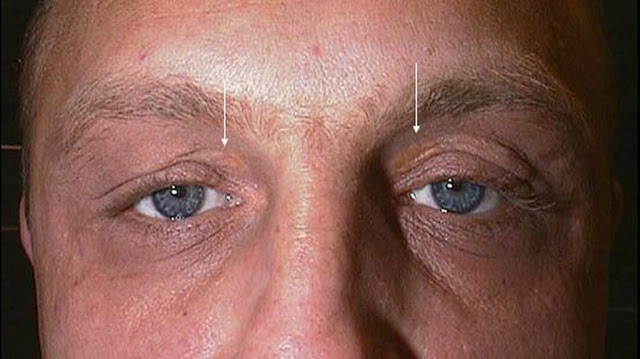 Ποια σημάδια στα μάτια σας αποκαλύπτουν την αύξηση της χοληστερίνης σας; - Φωτογραφία 3