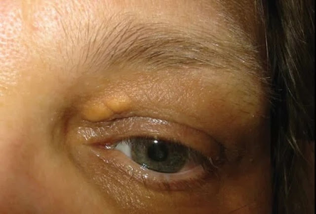 Ποια σημάδια στα μάτια σας αποκαλύπτουν την αύξηση της χοληστερίνης σας; - Φωτογραφία 4