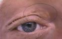 Ποια σημάδια στα μάτια σας αποκαλύπτουν την αύξηση της χοληστερίνης σας; - Φωτογραφία 2