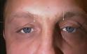 Ποια σημάδια στα μάτια σας αποκαλύπτουν την αύξηση της χοληστερίνης σας; - Φωτογραφία 3