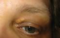 Ποια σημάδια στα μάτια σας αποκαλύπτουν την αύξηση της χοληστερίνης σας; - Φωτογραφία 4