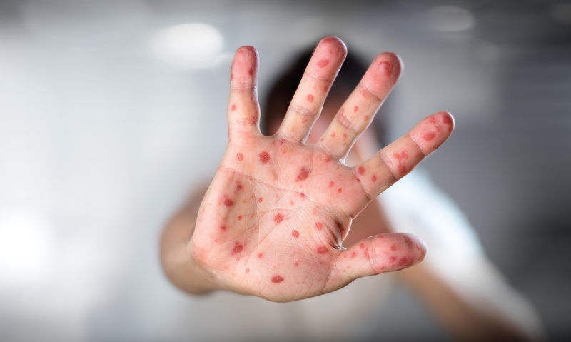 Μία 35χρονη το τρίτο θύμα της ιλαράς - Προβληματισμός στο ΚΕΕΛΠΝΟ - Φωτογραφία 1