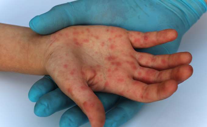 Πρόεδρος ΚΕΕΛΠΝΟ: Προβληματισμός για την επιδημία ιλαράς που δεν φαίνεται να σταματάει - Φωτογραφία 1