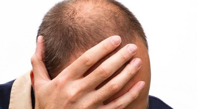 Γιατί κάποιοι άνδρες χάνουν πρόωρα τα μαλλιά τους; - Φωτογραφία 1