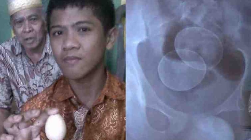 Ανεξήγητο φαινόμενο Οι επιστήμονες τρελάθηκαν: 14χρονος «γεννά» αυγά στην Ινδονησία - Φωτογραφία 1