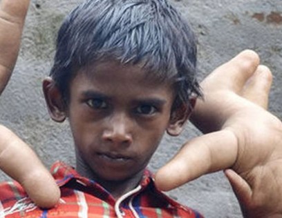 Ινδία: Η ιστορία του αγοριού με τα μεγαλύτερα χέρια στον κόσμο... [photo] - Φωτογραφία 1