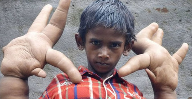 Ινδία: Η ιστορία του αγοριού με τα μεγαλύτερα χέρια στον κόσμο... [photo] - Φωτογραφία 3