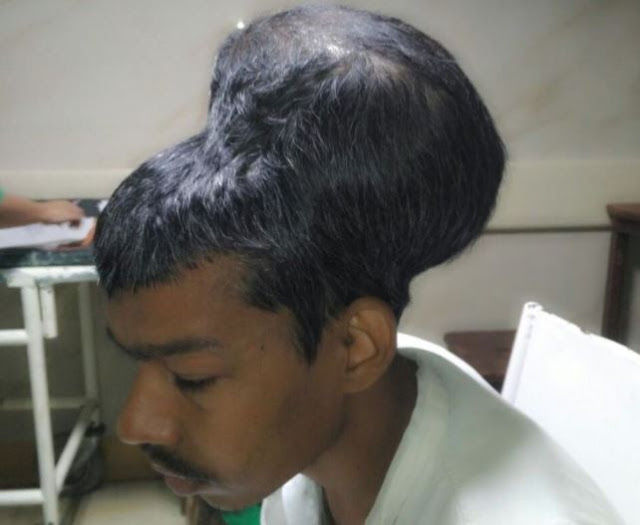 Ο μεγαλύτερος όγκος εγκεφάλου στην ιστορία! Τον αφαίρεσαν γιατροί στην Ινδία [photo] - Φωτογραφία 2