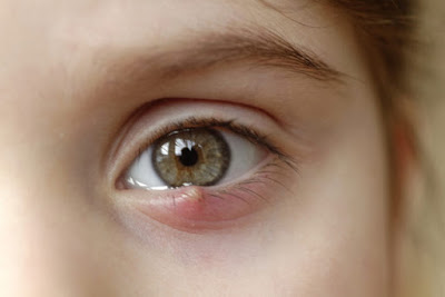 Τι είναι το χαλάζιο στο μάτι και σε τι διαφέρει από το κριθαράκι; Τι χρειάζεται να γίνει για να προληφθεί η υποτροπή; - Φωτογραφία 1