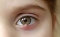 Τι είναι το χαλάζιο στο μάτι και σε τι διαφέρει από το κριθαράκι; Τι χρειάζεται να γίνει για να προληφθεί η υποτροπή; - Φωτογραφία 1