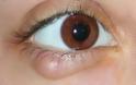 Τι είναι το χαλάζιο στο μάτι και σε τι διαφέρει από το κριθαράκι; Τι χρειάζεται να γίνει για να προληφθεί η υποτροπή; - Φωτογραφία 2