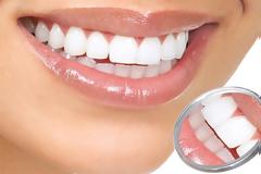 Λεύκανση δοντιών στο σπίτι: 10 εύκολα tips!