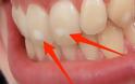 Πού οφείλονται αυτά τα λευκά σημάδια στα δόντια – Τι πρέπει να κάνετε