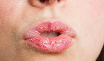 7 τρόποι να απαλλαγείτε από τα σκασμένα χείλη - Φωτογραφία 1