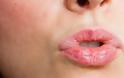 7 τρόποι να απαλλαγείτε από τα σκασμένα χείλη - Φωτογραφία 2