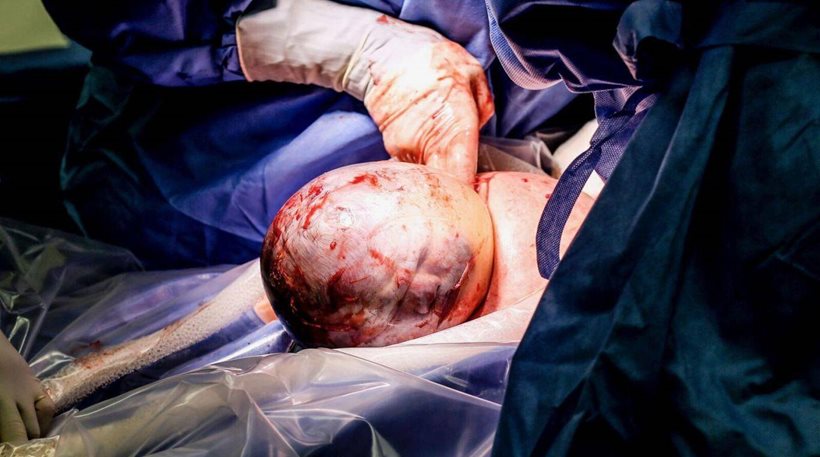 Απίστευτες εικόνες: Σπάνια γέννηση μωρού με το κεφάλι στον αμνιακό σάκο - Φωτογραφία 1
