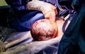Απίστευτες εικόνες: Σπάνια γέννηση μωρού με το κεφάλι στον αμνιακό σάκο