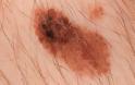 Καρκίνος του δέρματος: Ποια σημάδια πρέπει να σας οδηγήσουν κατευθείαν στο γιατρό; - Φωτογραφία 5