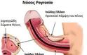 Νόσος Peyronie: Τι προκαλεί στα ανδρικά γεννητικά όργανα και πώς αντιμετωπίζεται; - Φωτογραφία 2