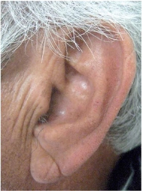 Από τα αυτιά φαίνεται ο κίνδυνος του … εγκεφαλικού! [ΕΙΚΟΝΕΣ] - Φωτογραφία 3