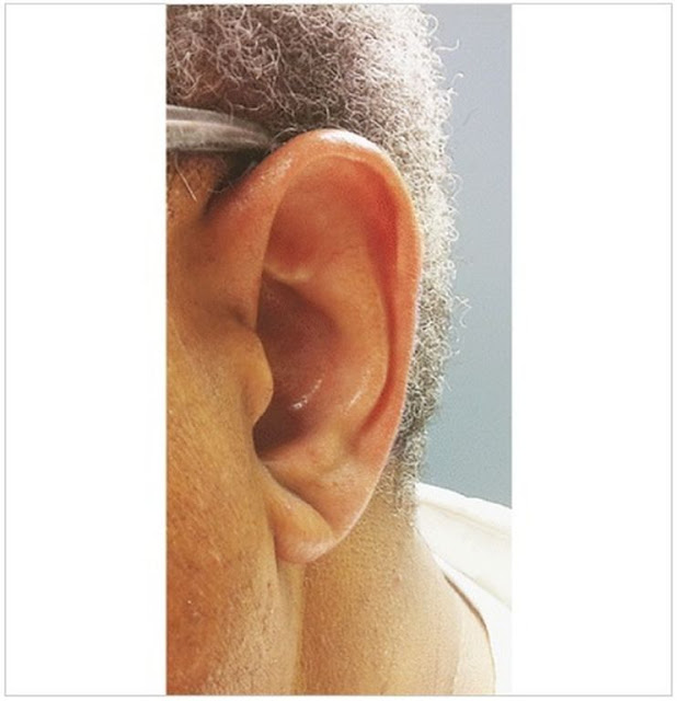 Από τα αυτιά φαίνεται ο κίνδυνος του … εγκεφαλικού! [ΕΙΚΟΝΕΣ] - Φωτογραφία 4