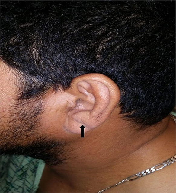 Από τα αυτιά φαίνεται ο κίνδυνος του … εγκεφαλικού! [ΕΙΚΟΝΕΣ] - Φωτογραφία 5