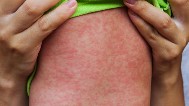 Επιδημία ιλαράς: Τα μισά κρούσματα εντοπίζονται στην Αττική! - Φωτογραφία 1
