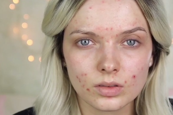 Skin Positivity: Η νέα τάση που αλλάζει ό,τι γνωρίζαμε για την ομορφιά και ανεβάζει την ψυχολογία μας! - Φωτογραφία 2