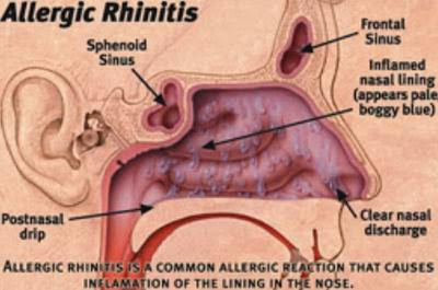 Αλλεργική ρινίτιδα, προκαλεί συνάχι, μπουκωμένη μύτη, πονοκέφαλο, φτέρνισμα, ξηρό βήχα. Πρόληψη και φυσικοί τρόποι αντιμετώπισης - Φωτογραφία 2