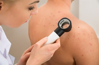 Κάντε το τεστ για να δείτε αν κινδυνεύετε περισσότερο από τον καρκίνο του δέρματος; - Φωτογραφία 1