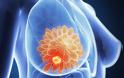 Καρκινικός δείκτης για τον καρκίνο του μαστού, το καρκινικό αντιγόνο 15-3 (CA 15-3) - Φωτογραφία 1