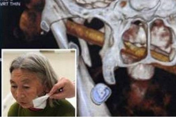 Οι γιατροί έπαθαν ΣΟΚ όταν ανακάλυψαν ότι στο πρόσωπό της είχε… [photo] - Φωτογραφία 1