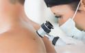 Καρκίνος του δέρματος: Καλύτερη η διάγνωση με την τεχνητή νοημοσύνη λένε οι δερματολόγοι