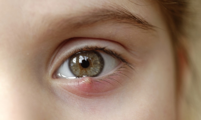 Κριθαράκι στο μάτι: Αίτια, θεραπεία και πρόληψη - Φωτογραφία 1