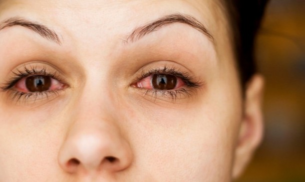 Αλλεργία στα μάτια: Αντιμετώπιση για φαγούρα, κοκκίνισμα και δάκρυα [video] - Φωτογραφία 1
