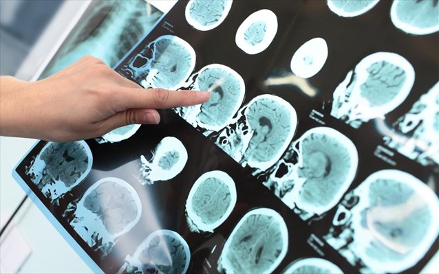 Έλληνες επιστήμονες ελέγχουν την αποτελεσματικότητα της εφαρμογής για την πρόβλεψη του Alzheimer - Φωτογραφία 1