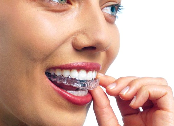 Αόρατος τρόπος για να ισιώσετε τα δόντια σας! - Φωτογραφία 1