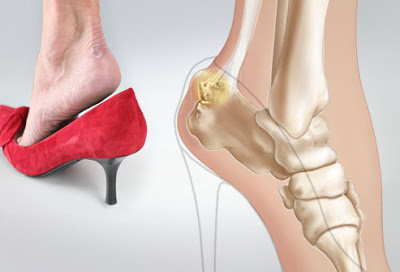 Προσοχή με τα τακούνια: Τι παθαίνουν τα πόδια – Χρόνια προβλήματα - Φωτογραφία 2