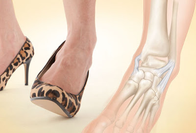 Προσοχή με τα τακούνια: Τι παθαίνουν τα πόδια – Χρόνια προβλήματα - Φωτογραφία 4