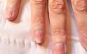 ΣΟΚΑΡΙΣΤΙΚΟ: Τα νύχια αυτής της γυναίκας καταστράφηκαν με κάτι που κάνουν όλες οι γυναίκες [photo] - Φωτογραφία 3