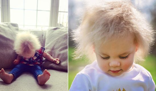 Γνωρίστε το μωρό που γεννήθηκε με το «σύνδρομο αχτένιστου μαλλιού»! - Φωτογραφία 1