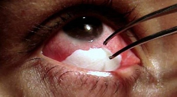 ΑΠΙΣΤΕΥΤΟ: Η Βραζιλιάνα με τα κρυστάλλινα δάκρυα - Μια σπάνια ασθένεια [photos] - Φωτογραφία 1
