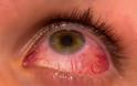 Επιπεφυκίτιδα με τσίμπλα, δάκρυα, πρήξιμο και κόκκινα ερεθισμένα μάτια - Φωτογραφία 1