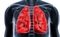 Καρκίνος του πνεύμονα: Έξι μύθοι και αλήθειες