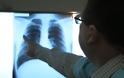 Καρκίνος του πνεύμονα: Έξι μύθοι και αλήθειες - Φωτογραφία 3
