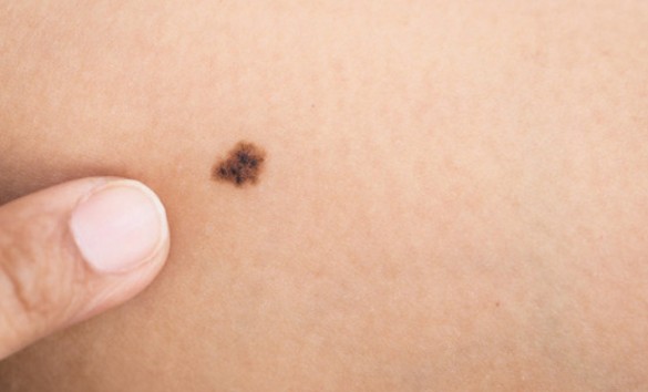 Ελιές στο δέρμα: Αυτά είναι τα 5 σημάδια που δείχνουν κίνδυνο για καρκίνο - Φωτογραφία 1
