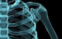Τι είναι το οστεοσάρκωμα και τι επιπτώσεις έχει στα οστά;