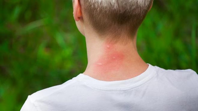 Ποια συμπτώματα μπορούν να υποδηλώνουν ότι είμαστε αλλεργικοί στο τσίμπημα κουνουπιού; - Φωτογραφία 2