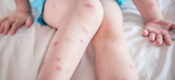 Ποια συμπτώματα μπορούν να υποδηλώνουν ότι είμαστε αλλεργικοί στο τσίμπημα κουνουπιού; - Φωτογραφία 3