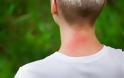 Ποια συμπτώματα μπορούν να υποδηλώνουν ότι είμαστε αλλεργικοί στο τσίμπημα κουνουπιού; - Φωτογραφία 2